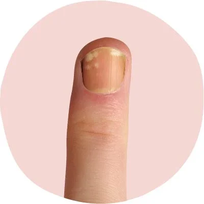 البقع-البيضاء-علامة-نقص-الزنك