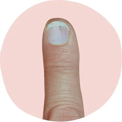 الخطوط-السوداء-نزيف-الشظايا-من-إصابة-إلى-عدوى