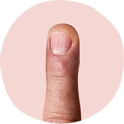 تقشير-الأظافر-صدمة-خارجية-أم-إشارة-داخلية